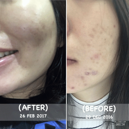 before-after-acne